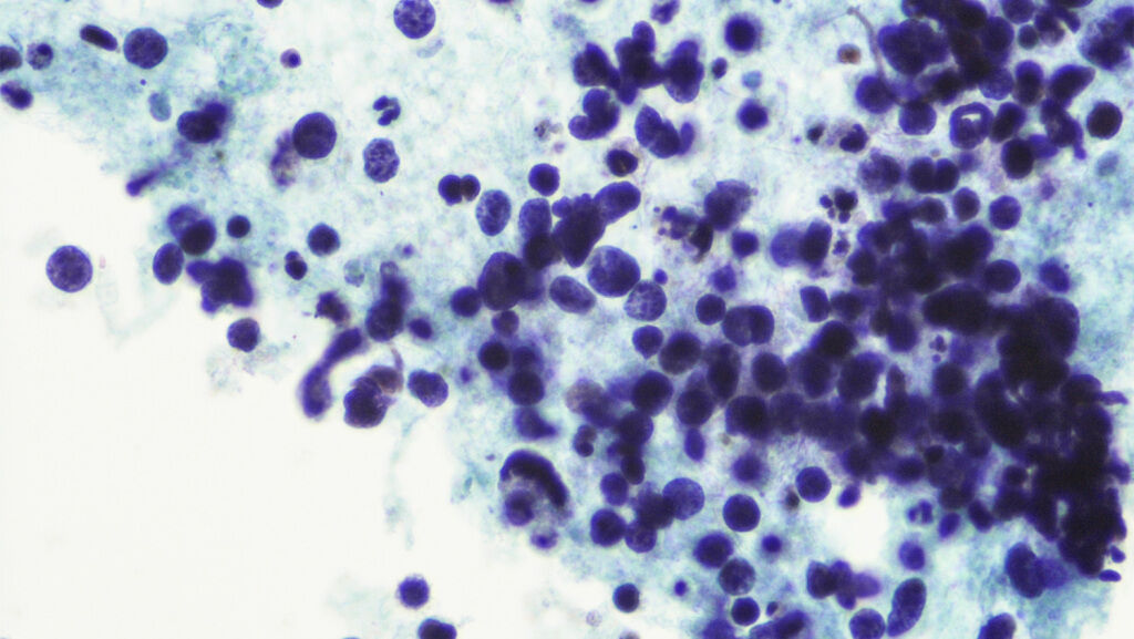 Microplastics Found in Lungs and Bloodstream